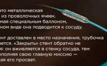 Все о стентировании сосудов сердца