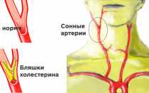 Что такое холестериновые бляшки в сосудах шеи и как это лечить?