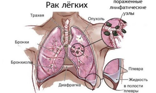 мелкоклеточный рак легкого